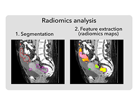 Integrative radiogenomics for virtual biopsy and treatment monitoring in ovarian cancer.
