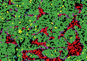 US Dept of Defence funds precision breast cancer research in Cambridge