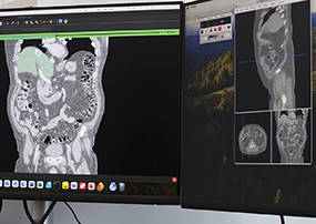 International research team receives $1 million to use AI to improve ovarian cancer care